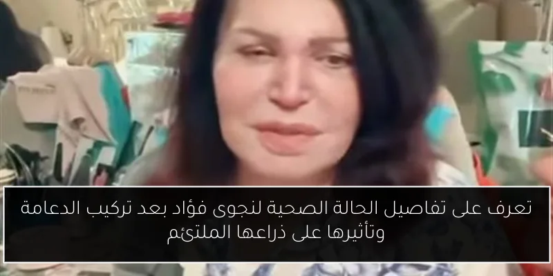 تعرف على تفاصيل الحالة الصحية لنجوى فؤاد بعد تركيب الدعامة وتأثيرها على ذراعها الملتئم